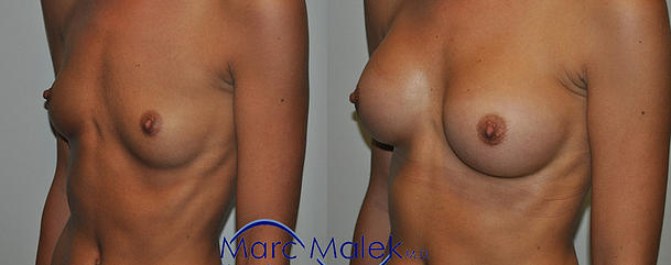 Breast Augmentation With Saline Before and After breastau