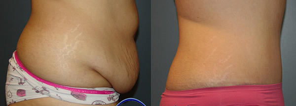 Abdominoplasty Before and After abdomino