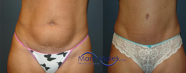 Abdominoplasty Before and After abdomino