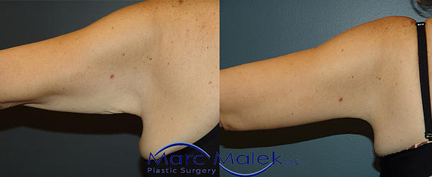 Brachioplasty Before and After brachiop