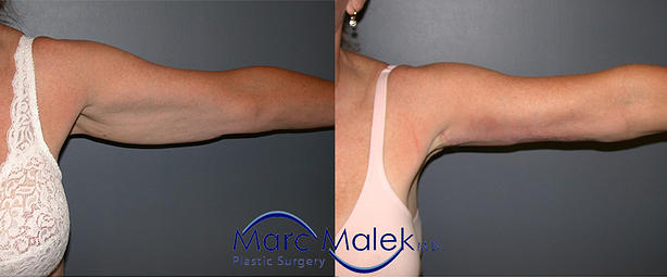 Brachioplasty Before and After brachiop