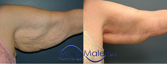 Brachioplasty Before and After brachiop
