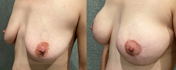Breast Augmentation With Lift Before and After breastau