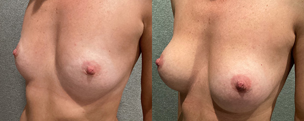 Breast Augmentation With Lift Before and After breastau