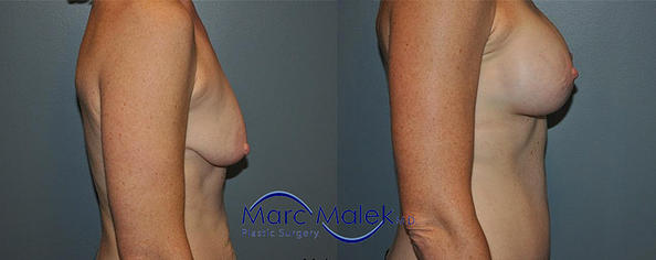 Breast Augmentation With Lift Before and After breastau