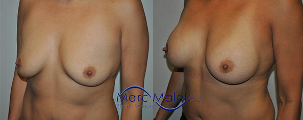 Breast Augmentation With Lift Before and After breastau