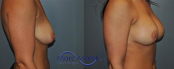 Breast Augmentation With Lift Before and After breastau