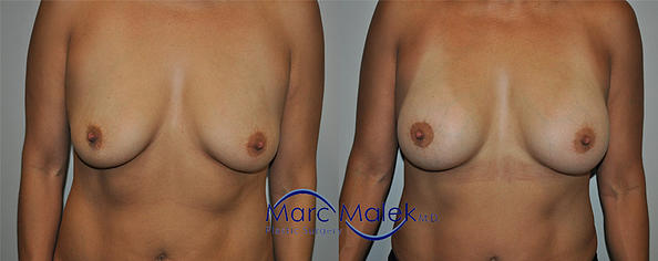 Breast Augmentation With Lift Before and After breastau