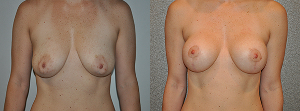 Breast Augmentation With Lift Before and After breastau