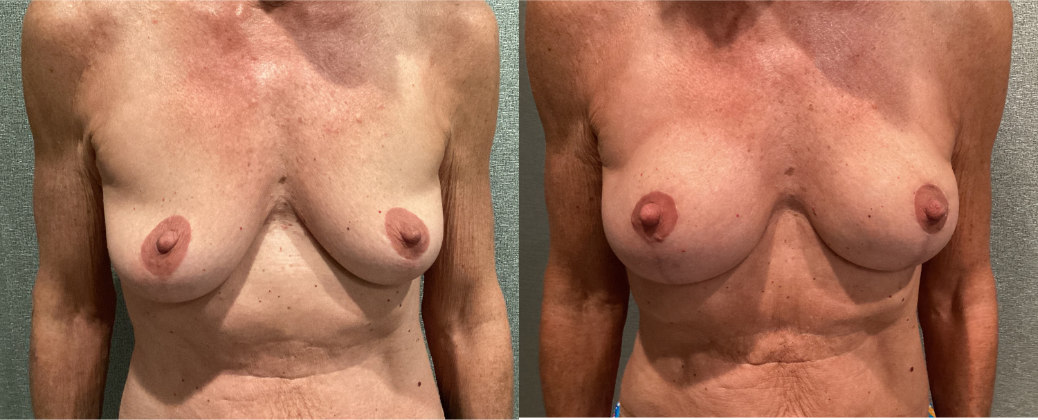 Breast Augmentation With Lift Before and After breastau