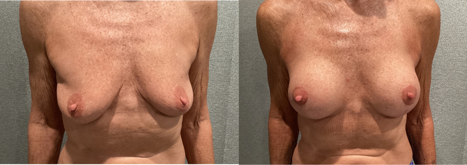 Breast Augmentation With Lift Before and After breastau