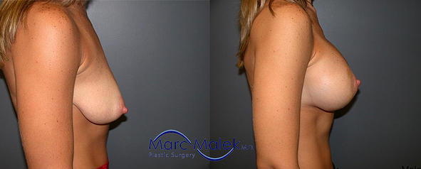 Breast Augmentation With Lift Before and After breastau
