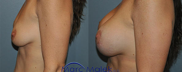 Breast Augmentation With Lift Before and After breastau