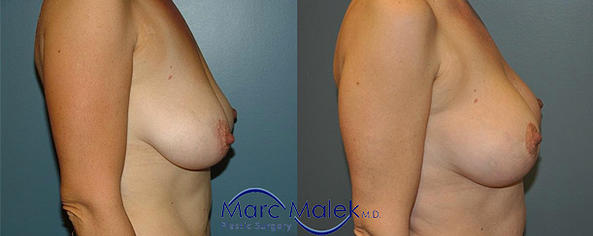 Breast Augmentation With Lift Before and After breastau