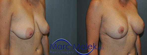Breast Augmentation With Lift Before and After breastau