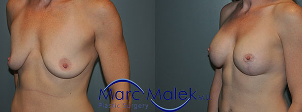 Breast Augmentation With Lift Before and After breastau