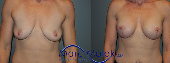 Breast Augmentation With Lift Before and After breastau