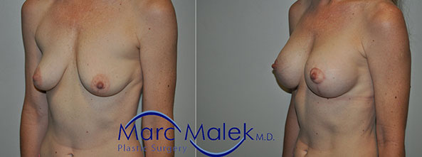 Breast Augmentation With Lift Before and After breastau