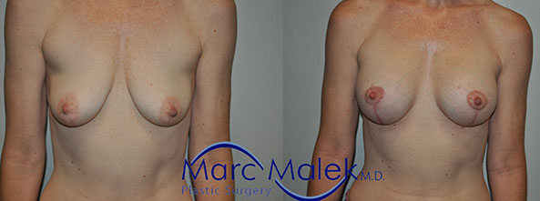 Breast Augmentation With Lift Before and After breastau