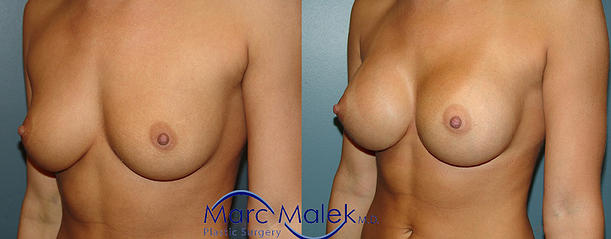 Breast Augmentation With Saline Before and After breastau