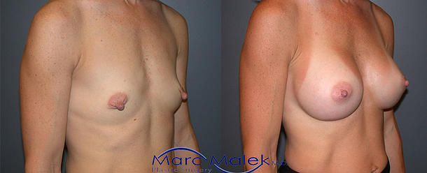 Breast Augmentation With Saline Before and After breastau