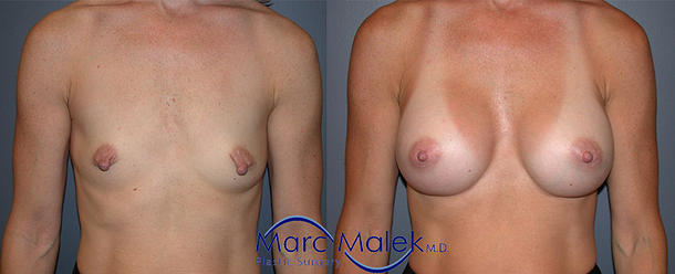 Breast Augmentation With Saline Before and After breastau