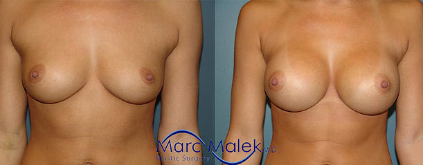 Breast Augmentation With Saline Before and After breastau