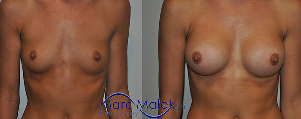 Phoenix Breast Augmentation Before & After
