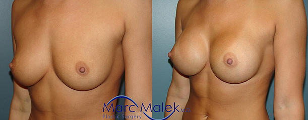 Phoenix Breast Augmentation Before & After