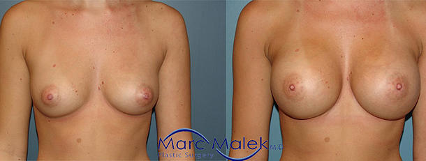 Breast Augmentation With Saline Before and After breastau
