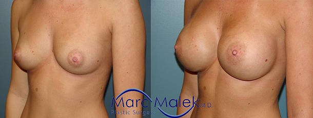 Breast Augmentation With Saline Before and After breastau