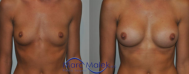 Breast Augmentation With Saline Before and After breastau