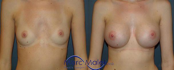 Breast Augmentation Scottsdale Before & After