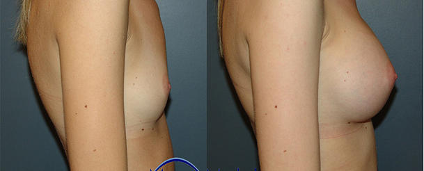 Breast Augmentation With Saline Before and After breastau