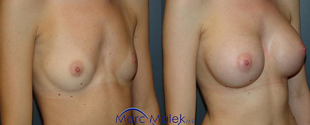 Breast Augmentation With Saline Before and After breastau