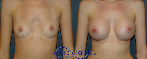 Breast Augmentation With Saline Before and After breastau