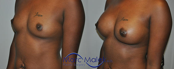 Breast Augmentation With Saline Before and After breastau