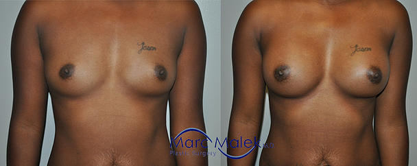Breast Augmentation With Saline Before and After breastau