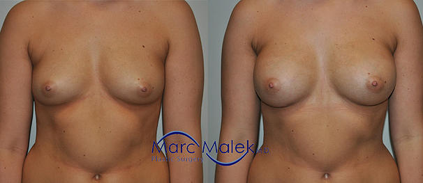 Breast Augmentation With Saline Before and After breastau