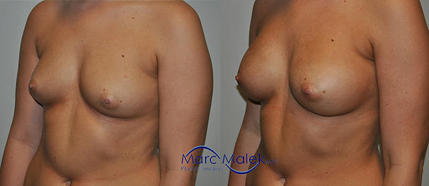 Breast Augmentation With Saline Before and After breastau