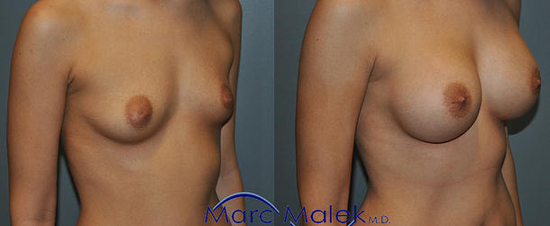 Breast Augmentation With Saline Before and After breastau