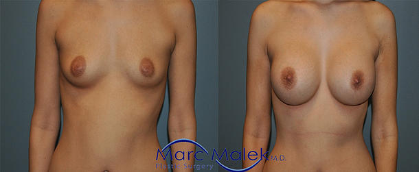Breast Augmentation With Saline Before and After breastau