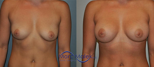 Breast Augmentation With Saline Before and After breastau