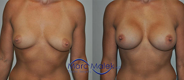 Breast Augmentation With Saline Before and After breastau