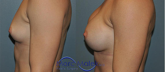 Breast Augmentation With Saline Before and After breastau