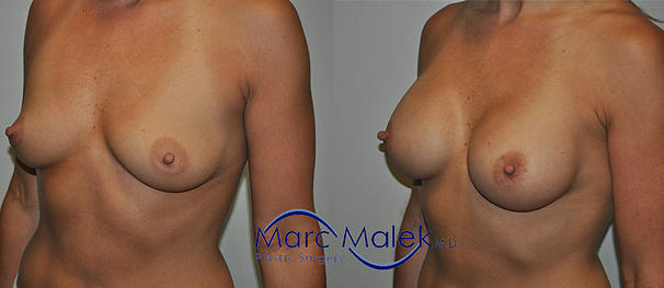 Breast Augmentation With Saline Before and After breastau
