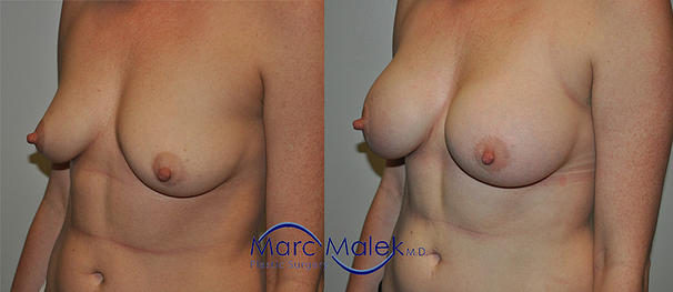 Breast Augmentation With Saline Before and After breastau