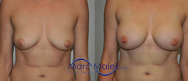 Breast Augmentation With Saline Before and After breastau