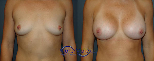 Breast Augmentation With Saline Before and After breastau