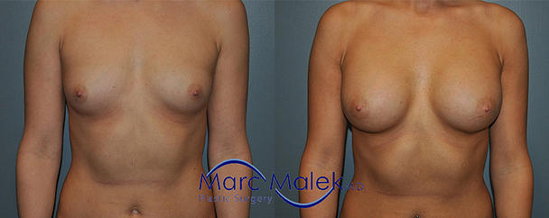 Breast Augmentation With Saline Before and After breastau